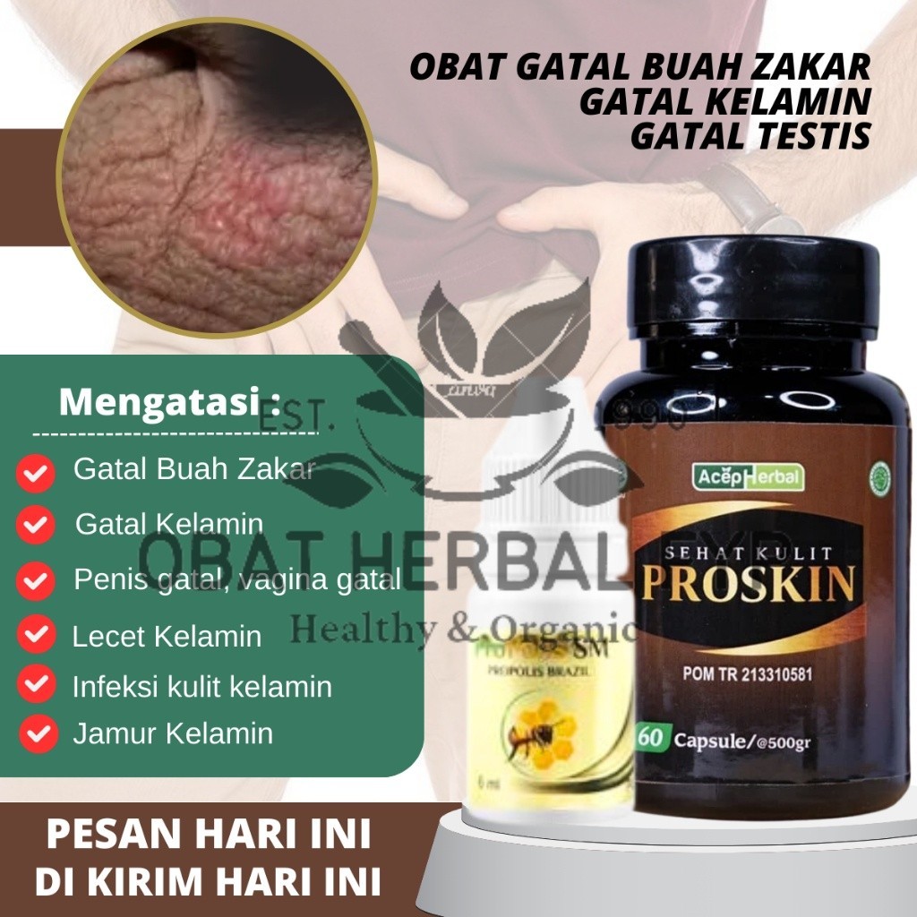 Propolis SM - Obat Ruam Di Buah Zakar, Obat Gatal Biji Pelir, Obat Gatal Testis, Obat Bentol Bernana
