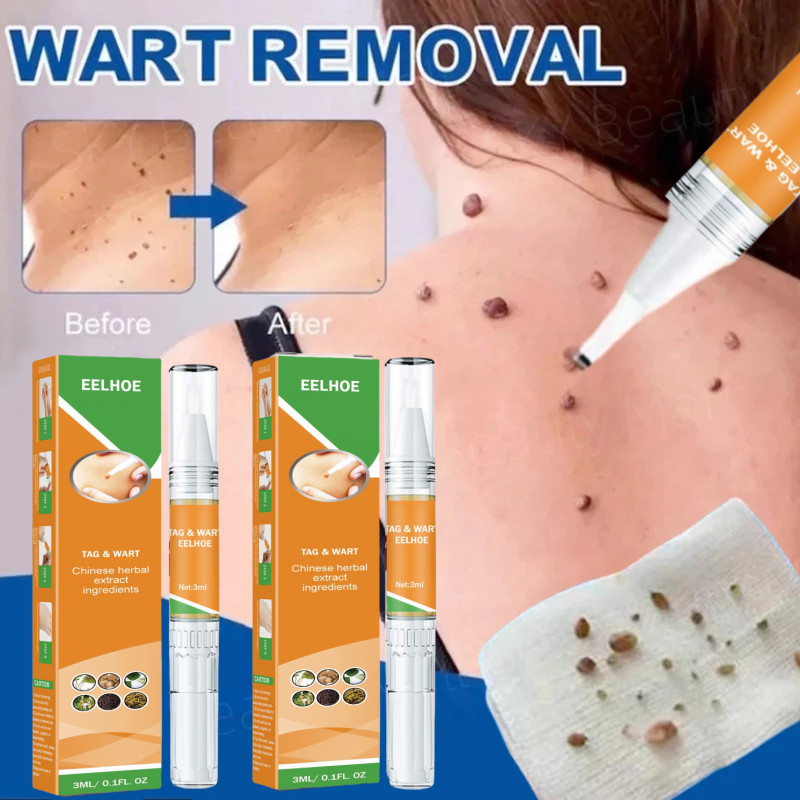 EELHOE Wart Remover Pen Krim Penghilang Lalat, Krim Penghilang Kutil, Krim Penghilang Kutil