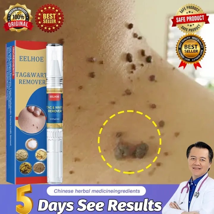 【EELHOE】Penghilang Kutil Wart Removal Pen Cream Krim Penghilang Lalat, Krim Penghilang Kutil, Mudah 
