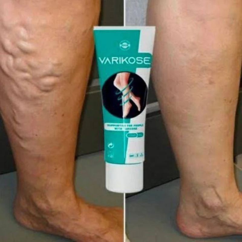 VARIKOSE 100% ORIGINAL CREAM MENGATASI VARISES - OBAT STRECK MARCK AMPUH BPOM