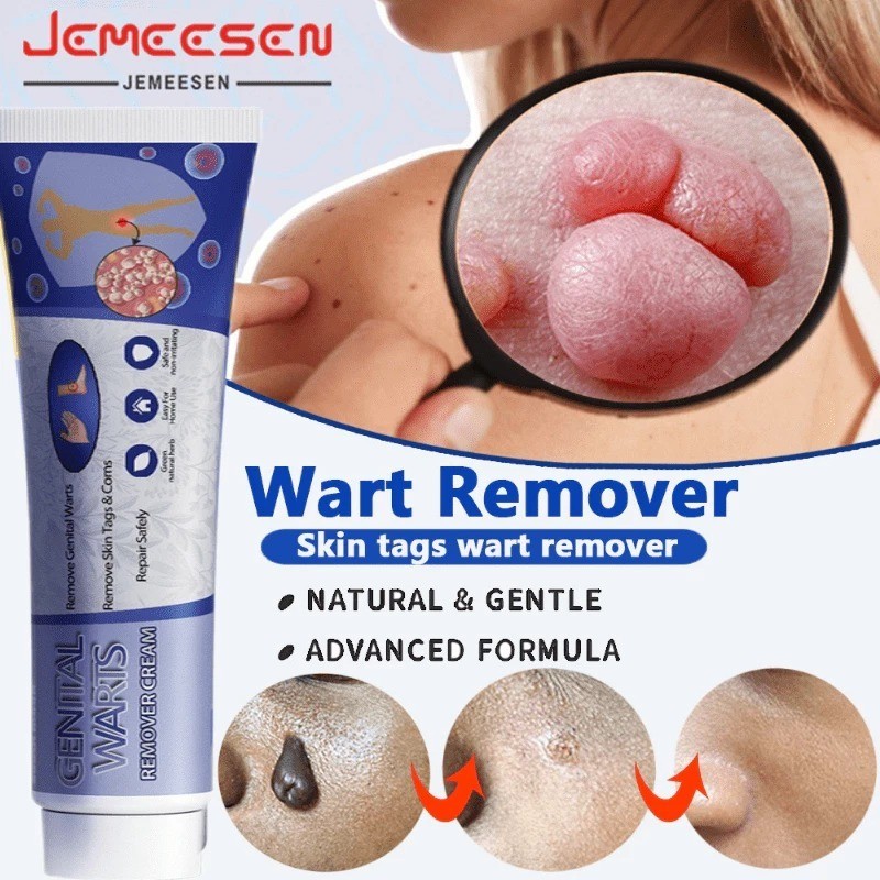 Obat Salep Kutil Kelamin, Perontok Kutil, Perontok Tahi Lalat, Salep Penghilang Kutil, Salep Penghil