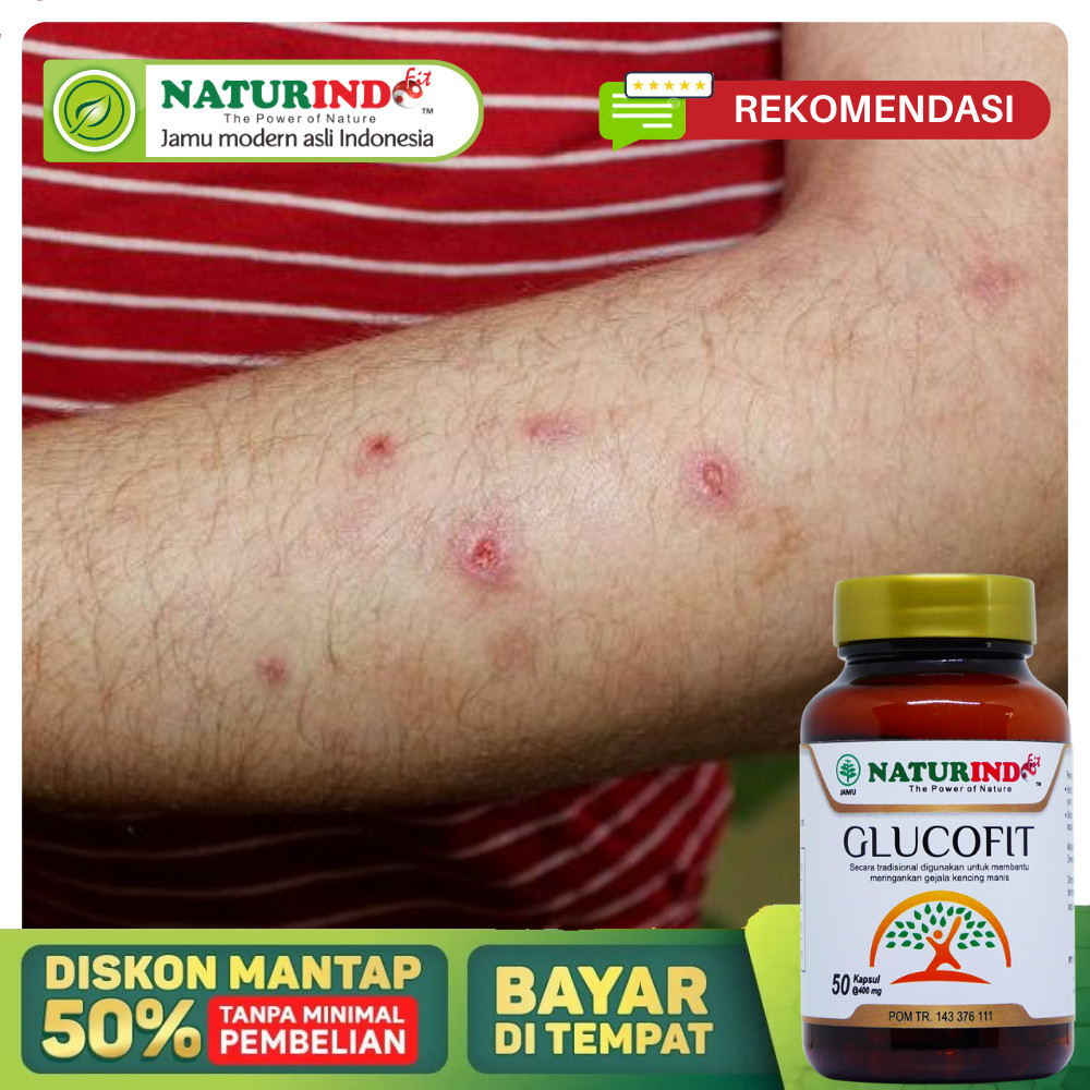 Obat Penyakit Darah Manis Gatal Gatal Kulit Peradangan Kulit Ruam Merah Kulit Gatal bernanah herbal 