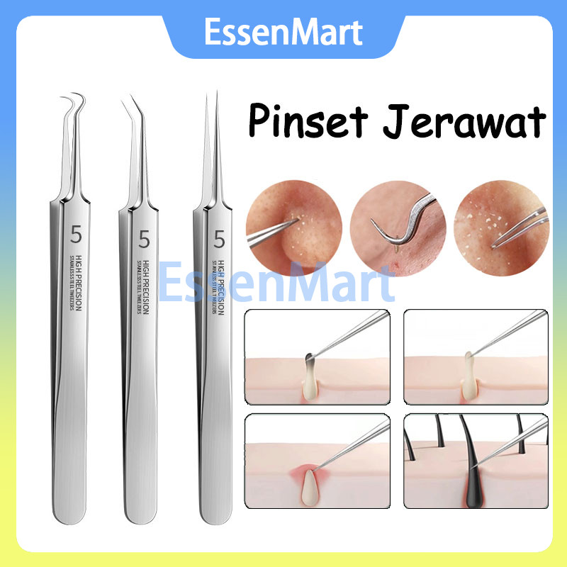 Alat Pencet Jerawat Dan Komedo / Alat Pencet Jerawat Dan Komedo Free Box Alat Pembersih Komedo Pinse