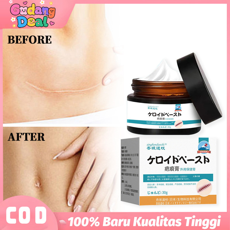 [Promo] Krim Penghilang Bekas Luka - Bekas Jahitan, Gigitan Nyamuk, Luka Bakar & Stretch Mark