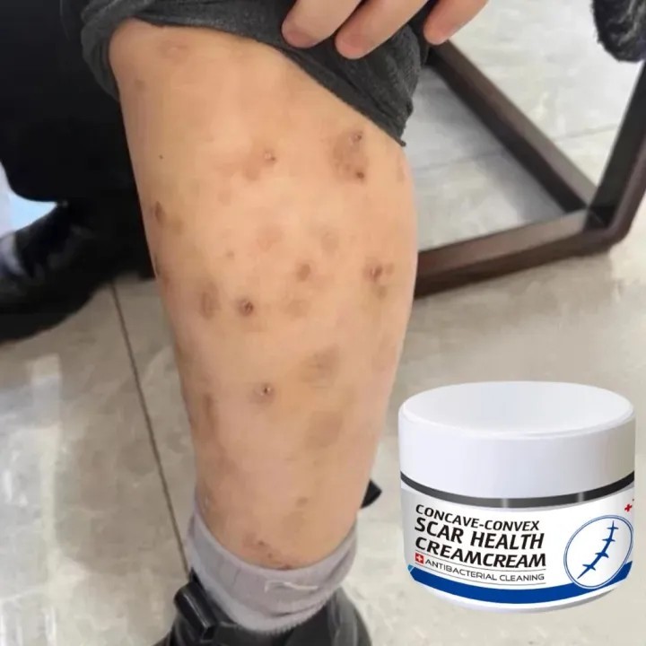 Scar remover cream Scar Remover Cream for Old Scars Stretch Marks New Scars Acne Scars Remover Gel S