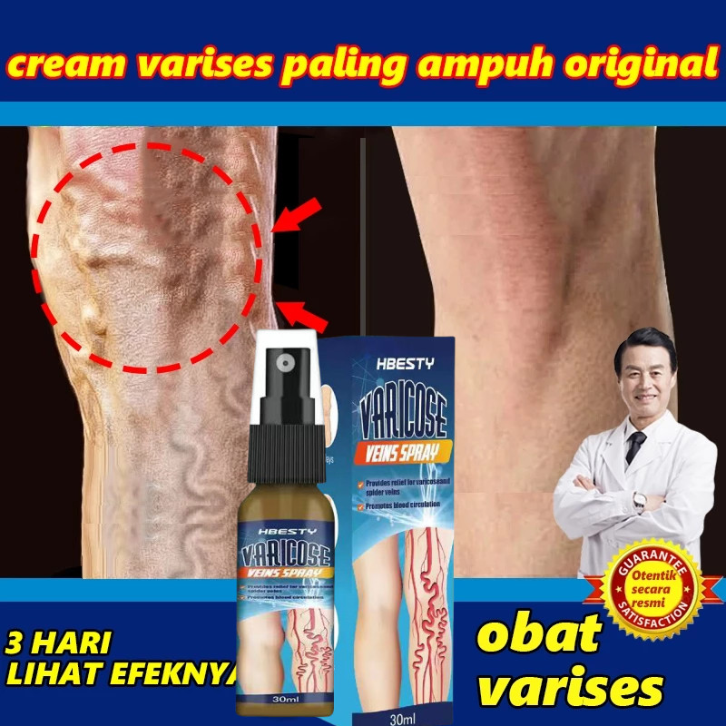 Varises original obat parises kaki paling ampuh salep varises 30MLSpray laba-laba Pengobatan Vaskuli