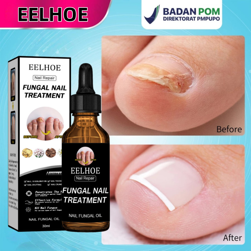 Obat jamur kuku obat kuku jamur dan rusak obat cantengan jempol kaki perawatan kuku 30ML obat kuku j