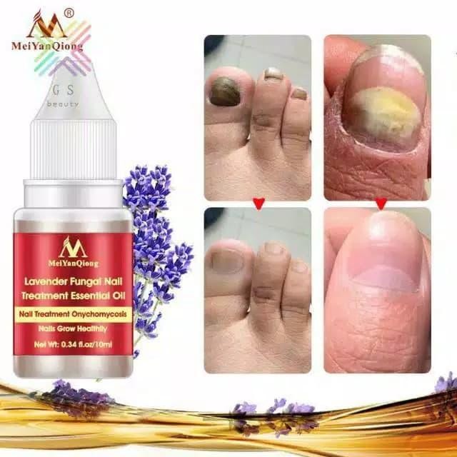 meiyanqiong obat anti jamur kuku nail treatment anti fungal jamur kuku