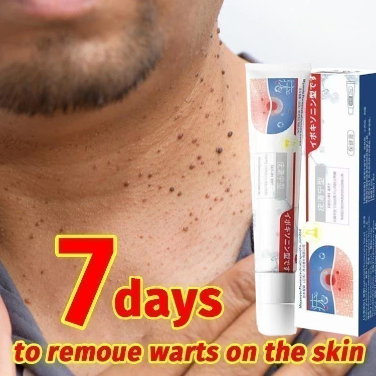 Penghilang Kutil Salep kutil paling ampuh Skin Tag Remover Obat kutil di leher Penghilang kutil  Men