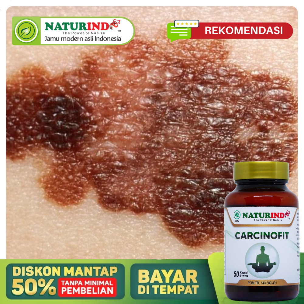 Obat Kanker Kulit Paling Ampuh, Obat Kanker kulit Melanoma, Obat Penghilang Kanker Kulit, Obat Benjo