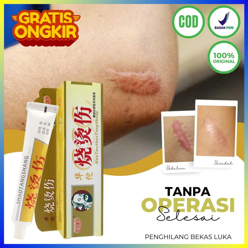 Obat Penghilang Bekas Luka Knalpot Salep Shao Tang Sang Penghilang Bekas Luka Koreng Hitam Gatal Kri