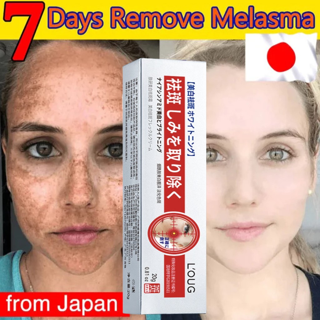 Japan Whitening Freckle Cream Remove Dark Spots Anti Freckle Cream Niacinamide Fade Pigmentation Mel