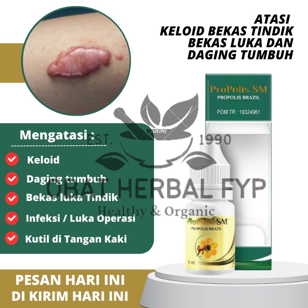 Obat Keloid, Obat keloid Luka tindik, Obat keloid daging tumbuh, Penghilang keloid daging tumbuh, Ob