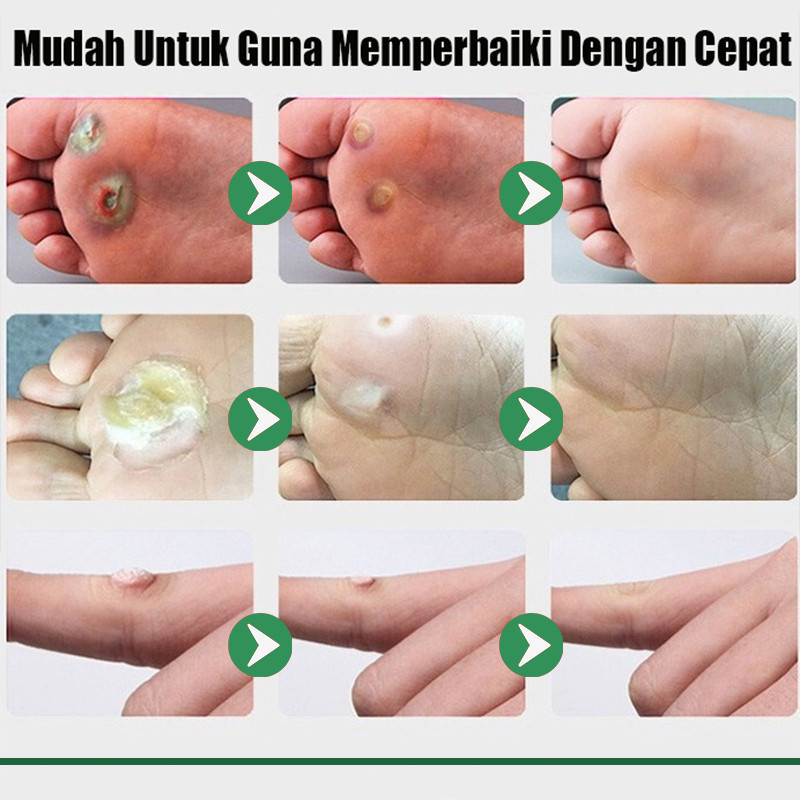PRAMU 10ml Obat Kutil Kelamin Leher Perontok Papiloma Wajah Obat HPV Kutilos Ampuh Herbal Obat Mata