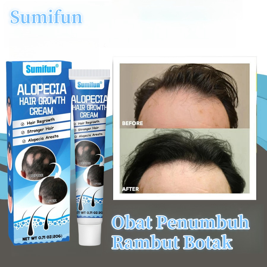 Obat Alopecia Areata, Obat Penumbuh Rambut Botak, Obat Botak Koin, Obat Rambut Pitak, Obat Penghilan