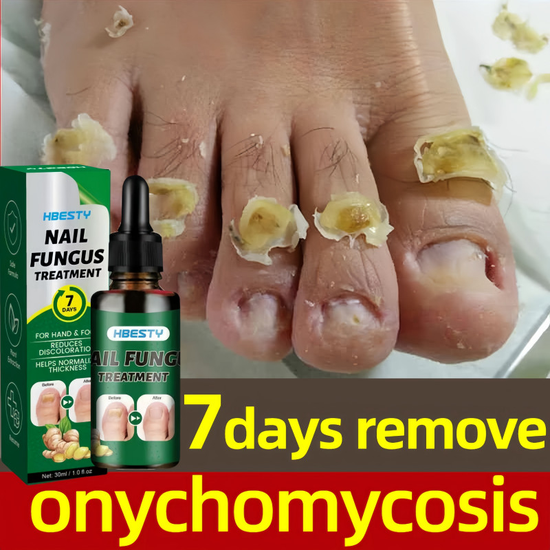 Obat Jamur Kuku Obat Kuku Jamur Dan Rusak Perawatan Onikomikosis Paronychia Anti Infeksi Kuku Toe Na