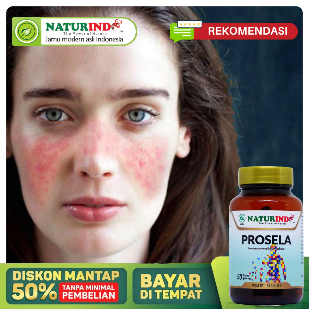 Obat Lupus Penyakit Autoimun Nyeri Dan Kaku Pada Sendi Ruam Kulit Gatal Gatal Sendi Kelelahan Ruam D