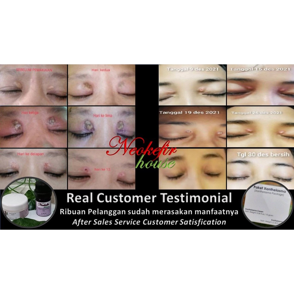 Paket Xanthelasma - obat salep xanthelasma 10gr dan minyak xanthelasma 5 ml - hilangkan lemak mata k