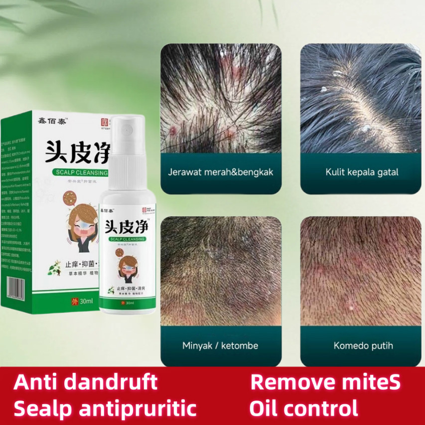 Semprotan Kulit Kepala 30ml Obat Ketombe Rambut Berkerak Kulit Kepala Gatal Ketombe Berkerak Ketombe
