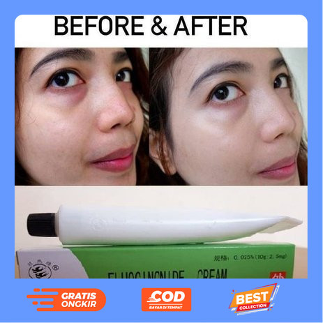 Fluocinonide Cream Salep Walet Penghilang Flek Hitam Jerawat Gatal Kudis Kurap Panu