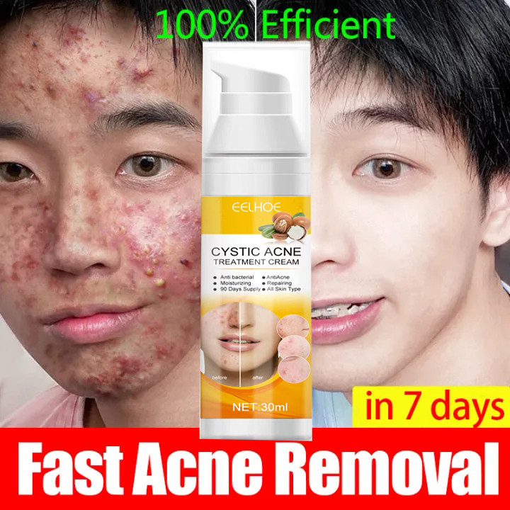 obat cina jerawat ampuh /obat jerawat cina paling ampuh 30ML /ANTI-ACNE Skin CREAM / Salep Krim Meng