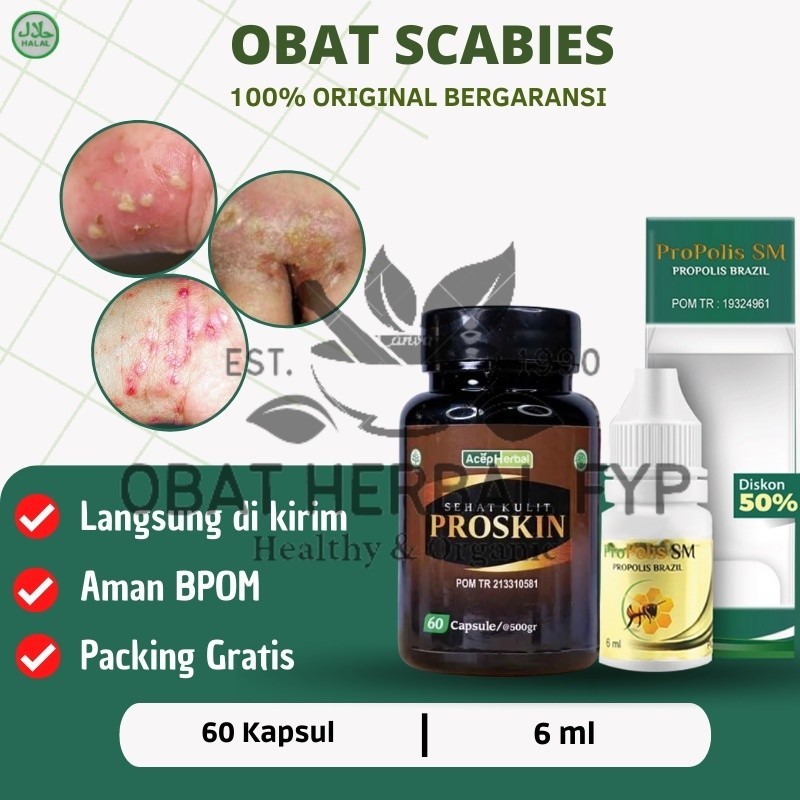 Proskin - Obat Scabies, Obat Scabies Manusia, Salep Scabies untuk manusia, Obat Scabies Kudis kurap 