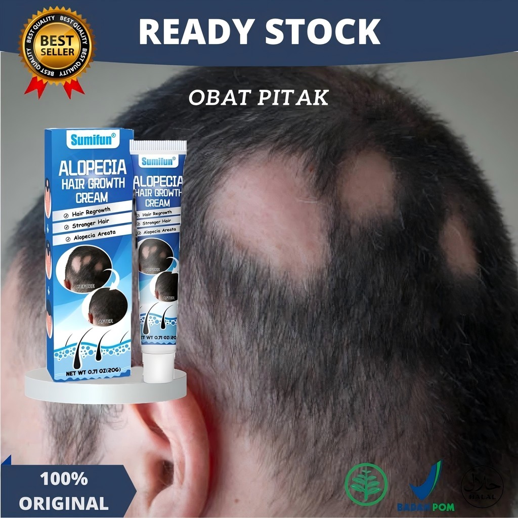 Obat Alopecia Areata, Krim Perawatan Rambut untuk Alopecia Areata dan Kebotakan 20g penumbuh rambut 