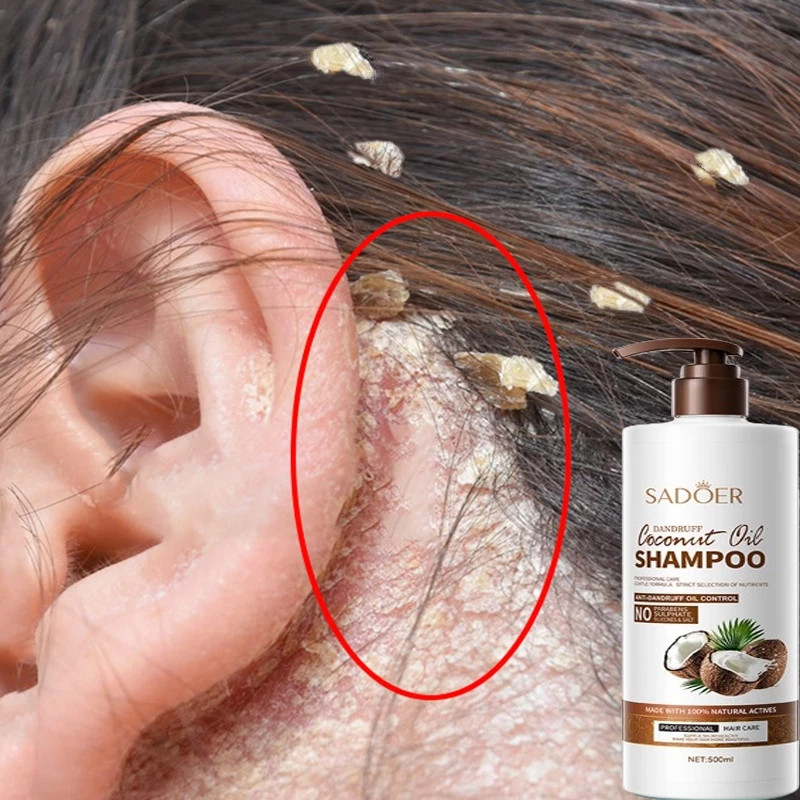 SADOER Ekstrak Kelapa Oil control Shampo anti ketombe Penghilang Ketombe Berkerak Dan Gatal obat ket