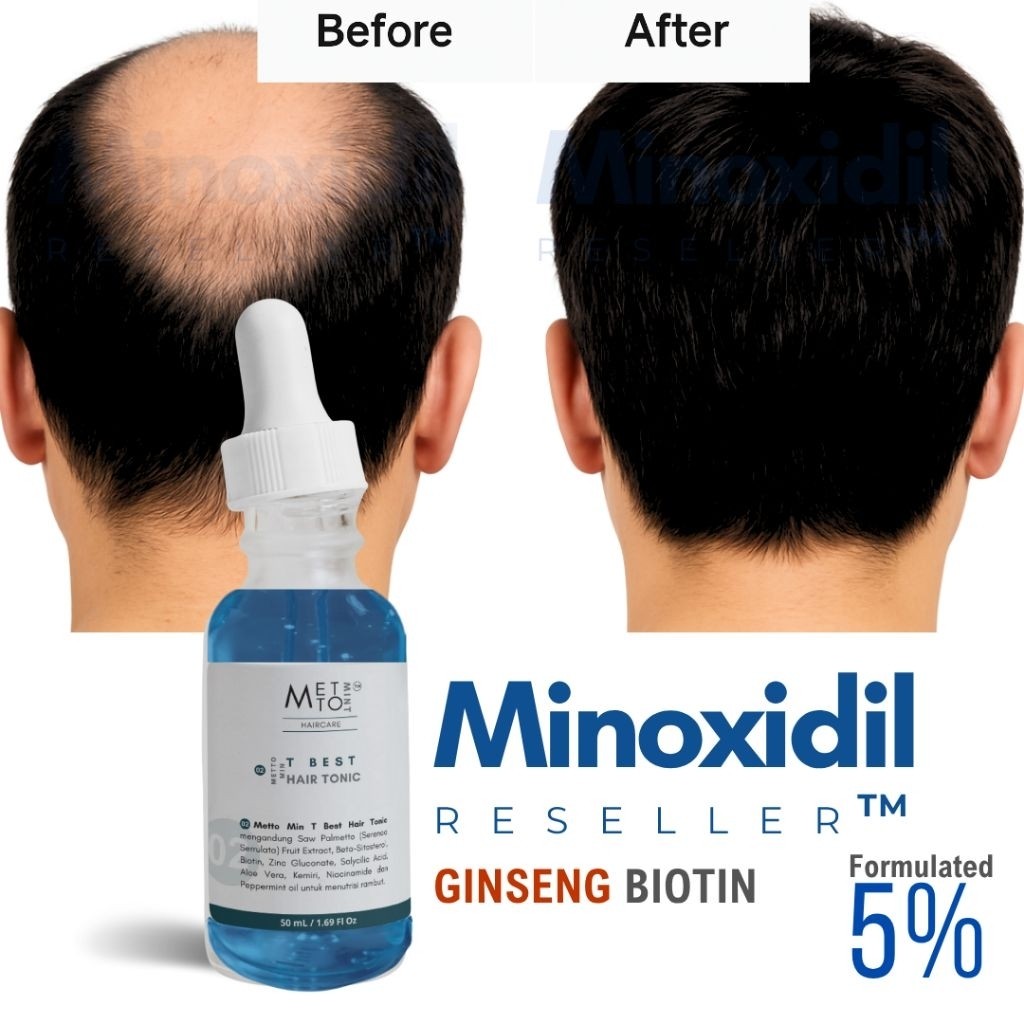 MINOXIDIL 5% Reseller Minox with Ginseng & Biotin Penumbuh Rambut Reseller Minoxidil 5% Minoxidil 10