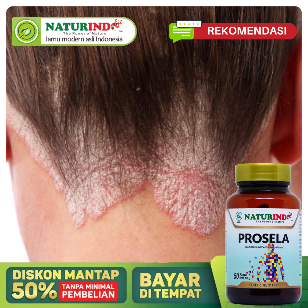 Obat Psoriasis Kepala Paling Ampuh, Infeksi Jamur Di Kulit Kepala, Kulit Kepala Berkerak, Borok Bern
