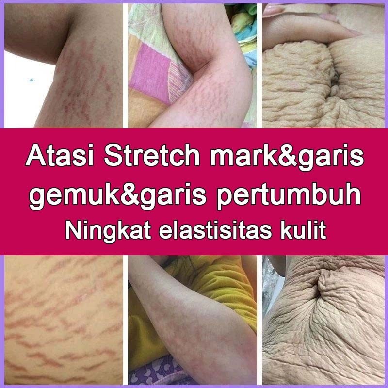 Krim Stretch Mark Cream Penghilang Stretch Mark Penghilangan Stretch Mark Permanen krim stretch mark