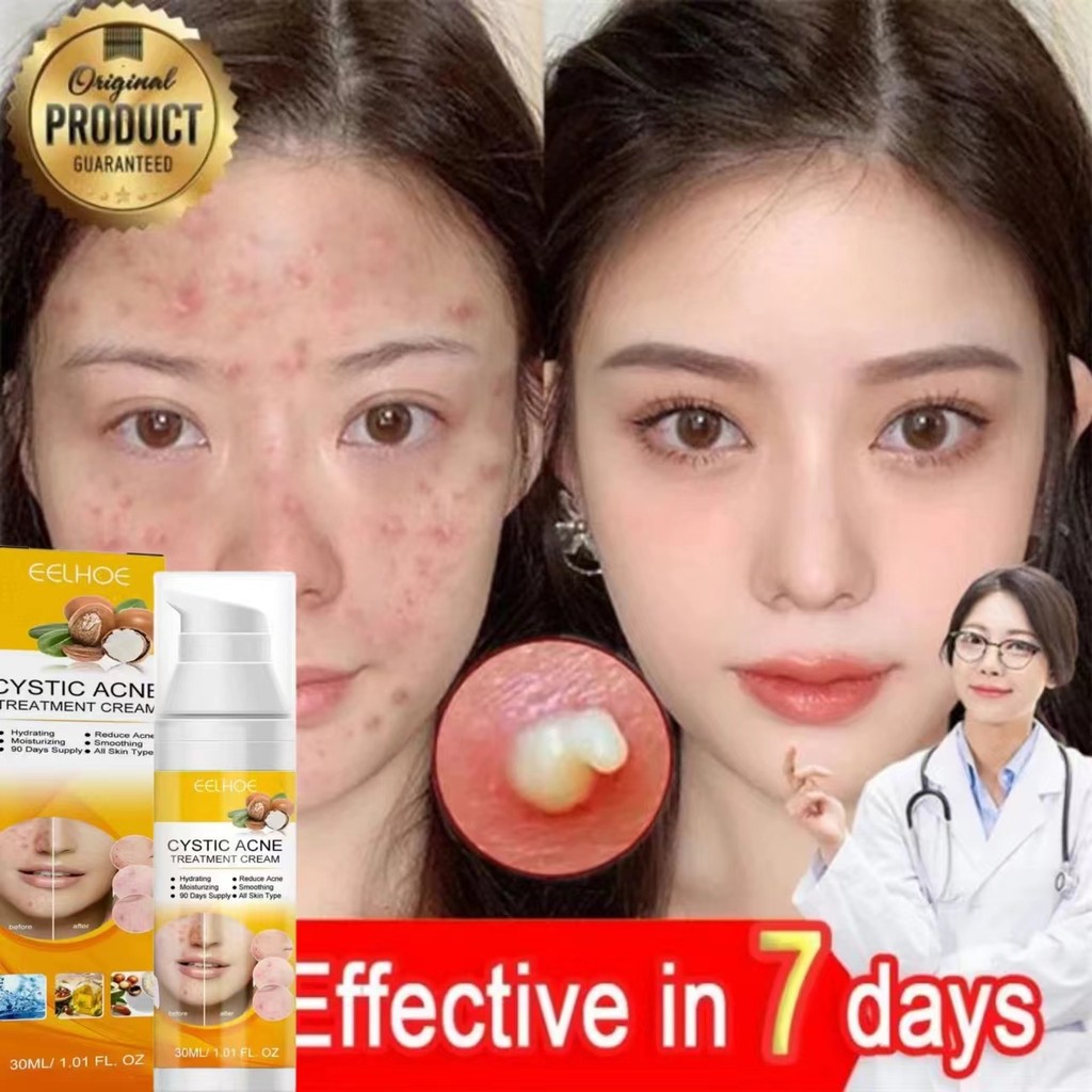 【100% Asli】obat jerawat ampuh /obat jerawat cina paling ampuh /ANTI-ACNE Skin CREAM / Salep Krim Men