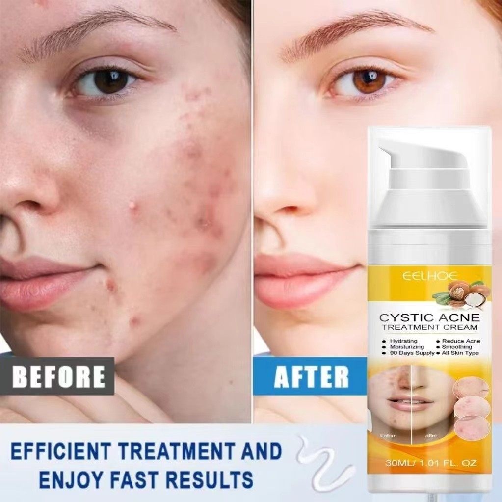 obat cina jerawat ampuh /obat jerawat cina paling ampuh 30ML /ANTI-ACNE Skin CREAM / Salep Krim Meng