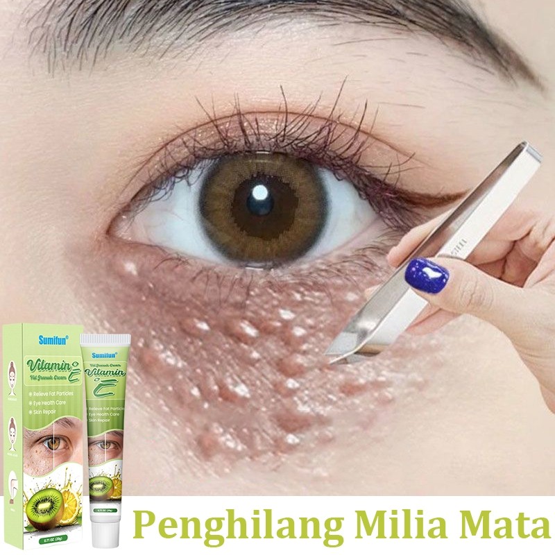 krim penghilang milia syringoma xanthelasma butiran lemak sekitar mata