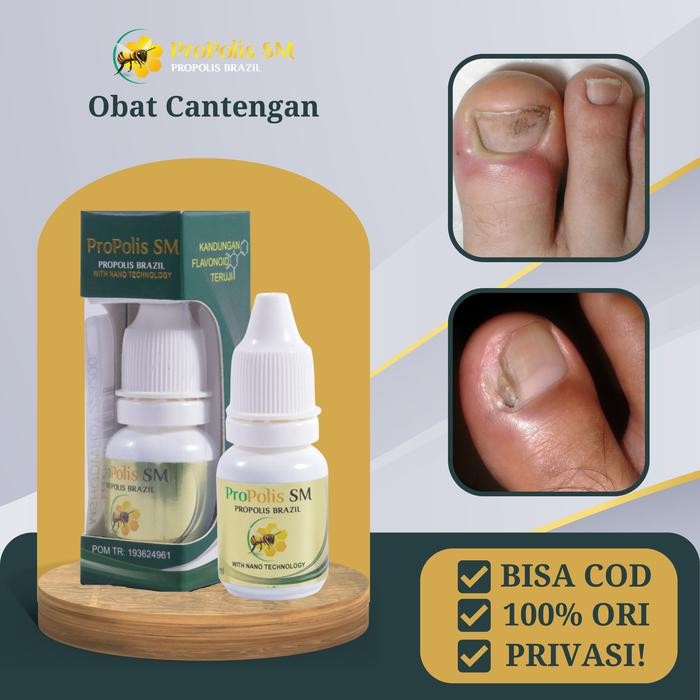 Salep Cantengan jempol kaki bengkak bernanah jamur kuku Telaris