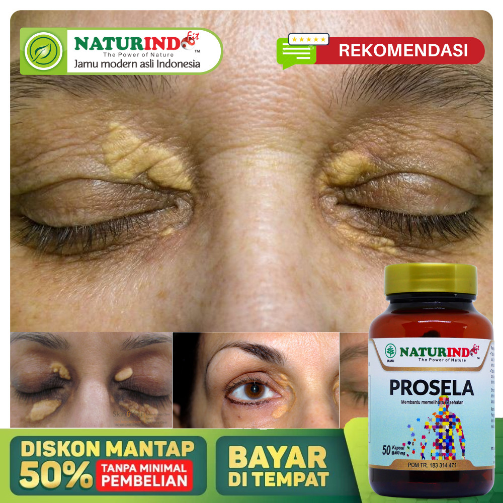 Obat Xanthelasma Paling Ampuh, Obat Penghilang Xanthelasma, Gumpalan Lemak Di Kelopak Mata, Lemak Ma