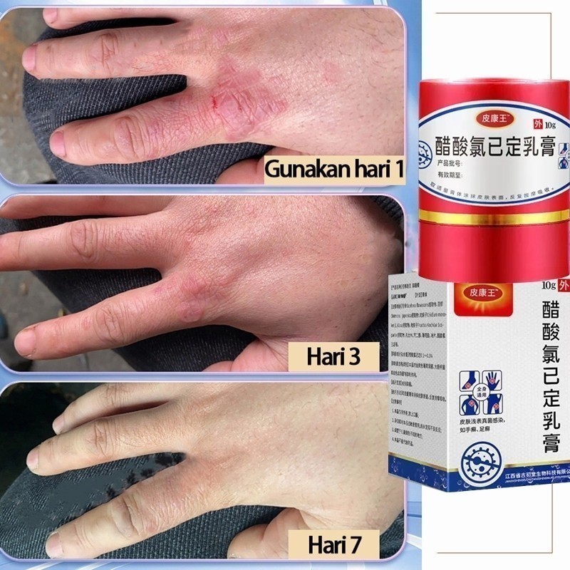 Kang Wang Ointment Ketoconazole Cream Pengobatan jerawat dan bekas jerawat Pengobatan gatal-gatal ya