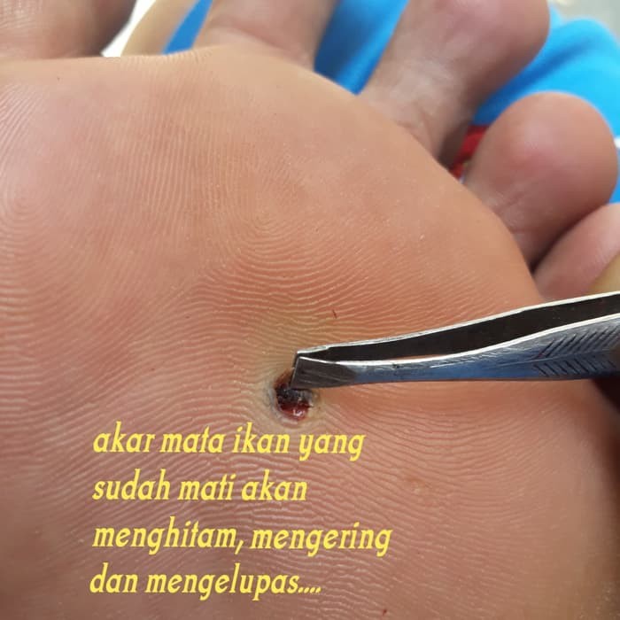 AG46YU Obat penyakit mata ikan atau clavus bukan plester salep callusol