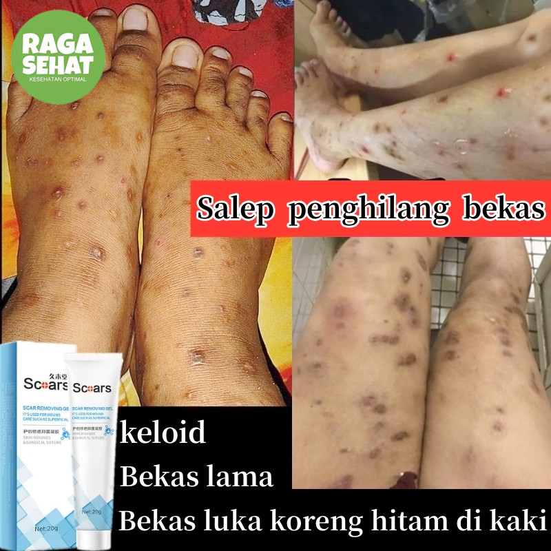 Salep penghilang bekas luka Penghilang bekas luka hitam koreng Penghilang bekas gigitan nyamuk