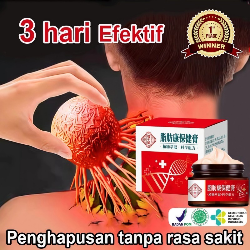 Lipoma Removal Cream 30g Herbal Cina Krim Obat Benjolan Lipoma Obat Lipoma Perawatan Punggung/Leher/