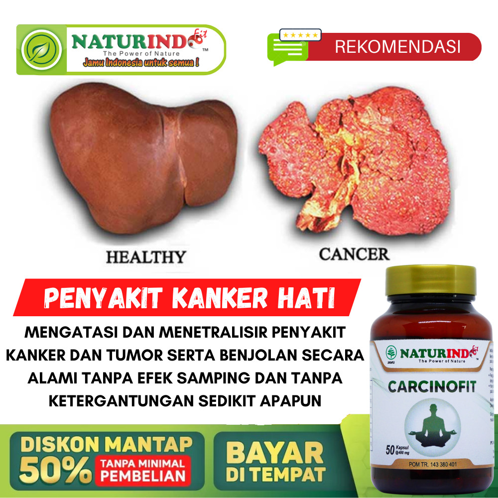 Obat Kanker Hati Paling Ampuh, Tumor Hati, Penyakit Kanker Dan Tumor, Pembengkakan Liver, Karsinoma 