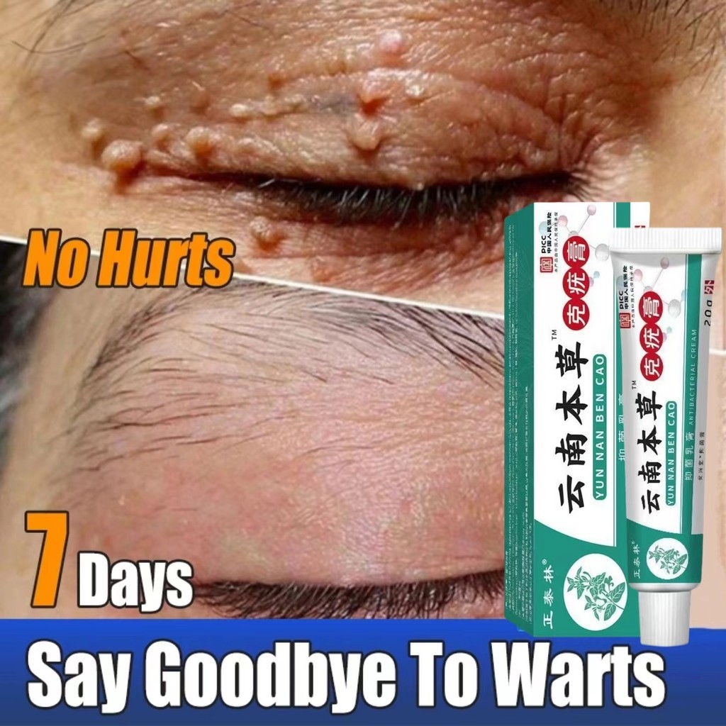 Wart and Mole Remover Wart Removal Cream Wart Removal Cream on the Face Bpom Most Powerful Wart Medi
