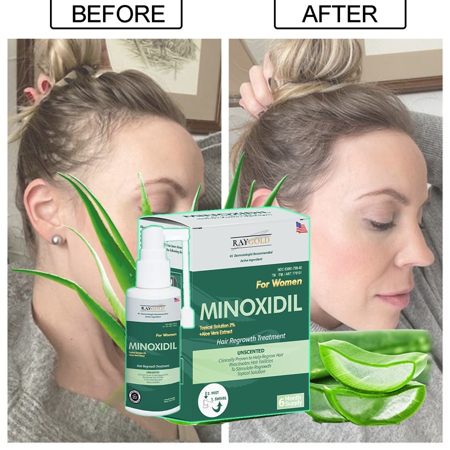 MINOXIDIL 2% for WOMEN penumbuh rambut with Aloe Vera made in USA - RAYGOLD - MINOX MINOKSIDIL MINOK