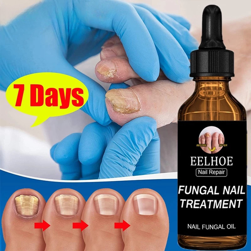 obat jamur kuku Perawatan Kuku Berjamur dan Rusak untuk Kuku Tangan dan Kaki Paronychia Lumut Perawa