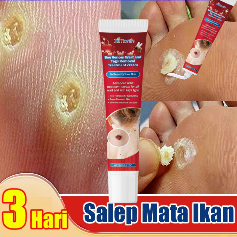Salep Mata Ikan Ampuh Obat Mata Ikan Kaki Penghilang Mata Ikan Obat Penghilang Kutil Dan Tahi Lalat 
