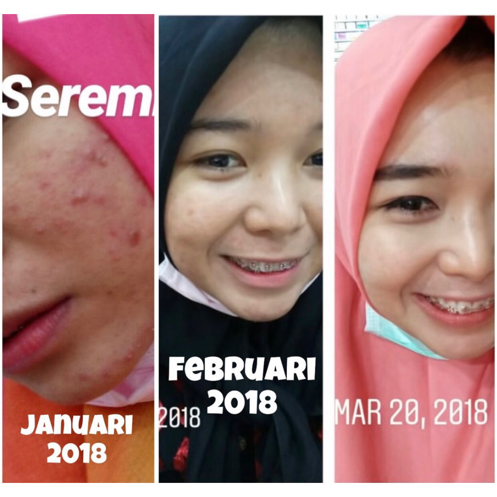 

New Hempass Jerawat TurkiPremium