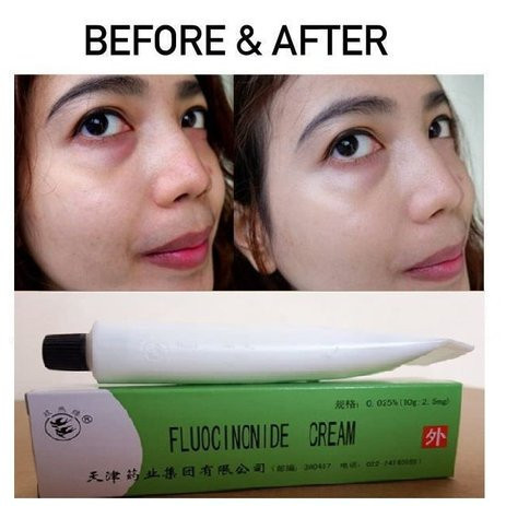 [TERMURAH] Fluocinonide Cream Salep Walet Penghilang Flek Hitam Jerawat Gatal Kudis Kurap Panu