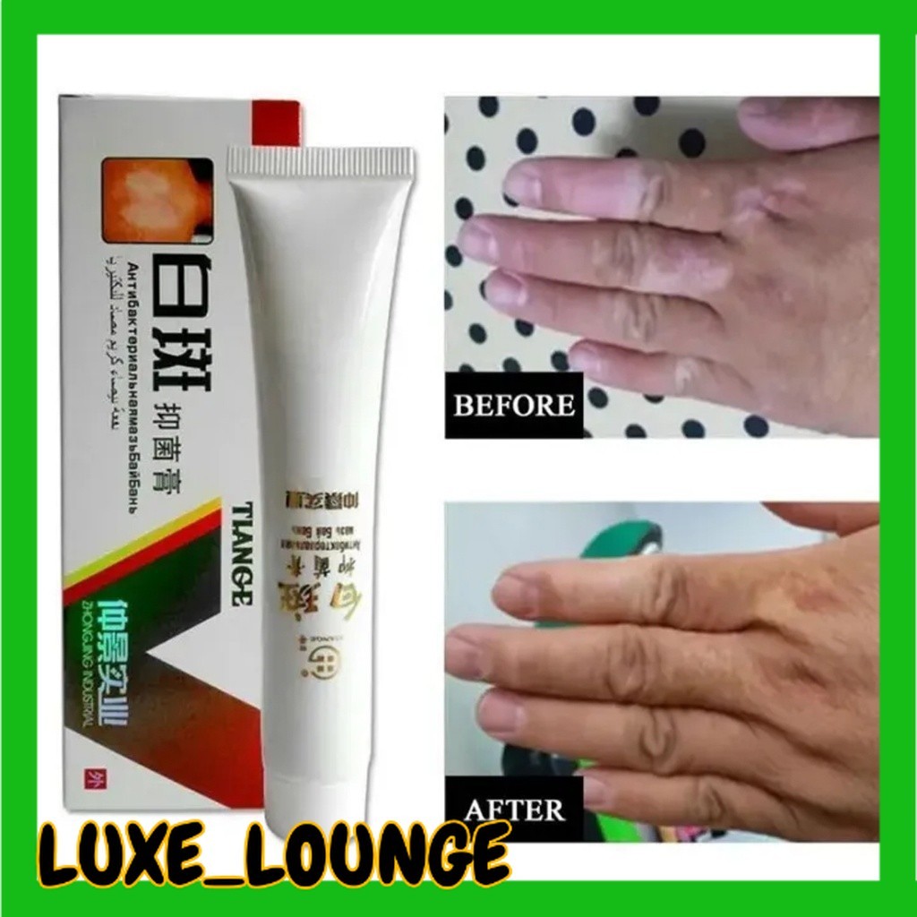 TIANGE Obat Salep Herbal China Tiange Untuk Vitiligo Penghilang Bercak Putih Bintik Putih
