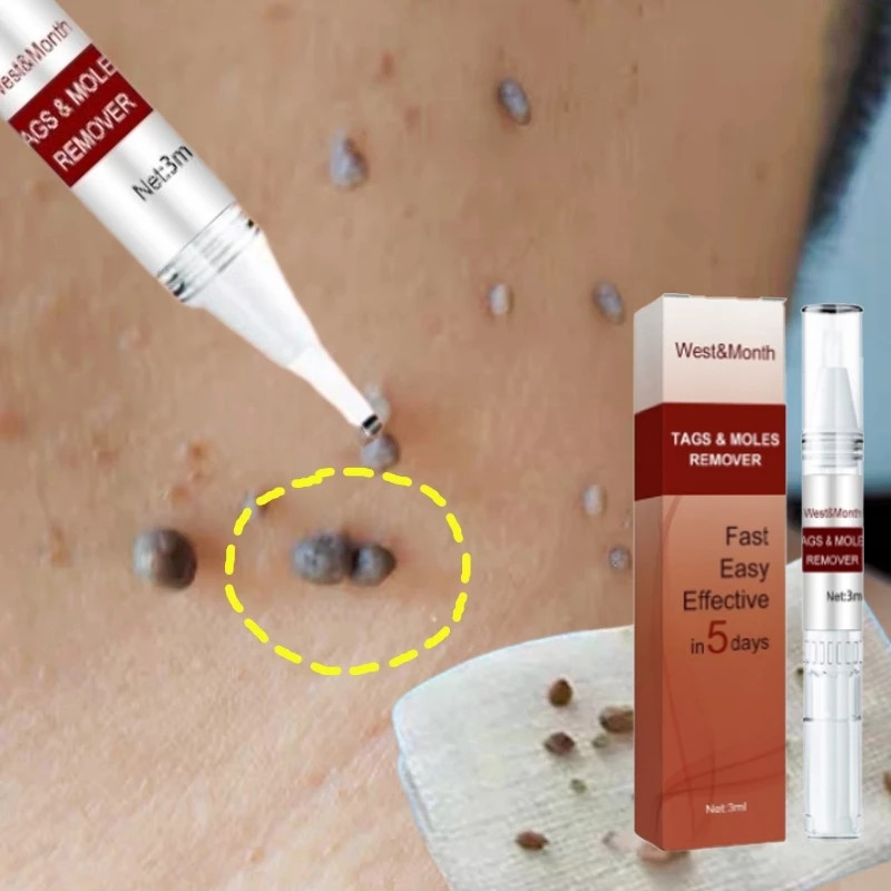 【100%ORI】Obat penghilang tahi lalat obat penghilang kutil obat kutil paling ampuh 100%Original obat 