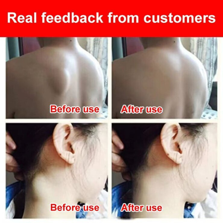 AMND Obat benjolan Obat lipoma Salep lipoma Salep benjolan 30g Obat Lipoma Obat Benjolan Penghilang